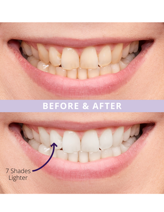 Before and after teeth whitening results with no sensitivity. 7 shades lighter in 14 days!