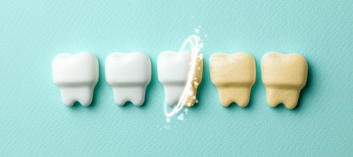 teeth whitening considerations