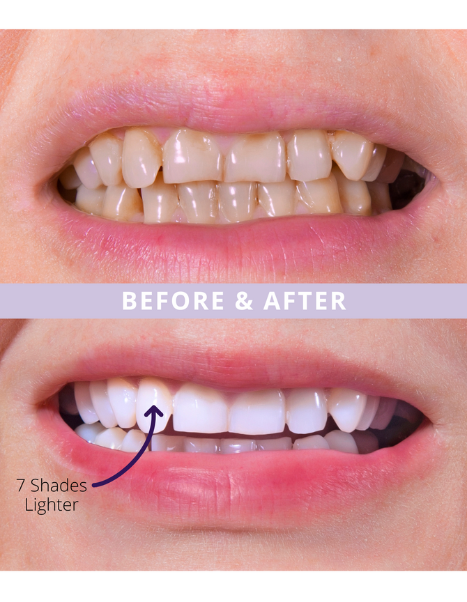 Magic Melt-Away Teeth Whitening by ELIMS. Clinically proven to lighten teeth upto 7 shades in 14 days. Totally enamel safe! Made for sensitive teeth. Before and after!