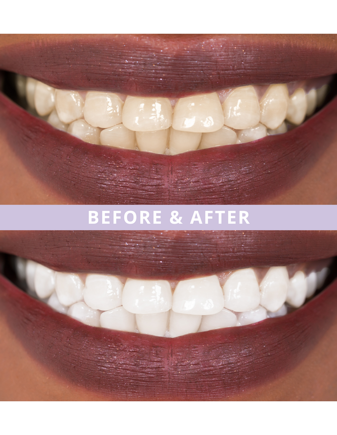 Magic Melt-Away Teeth Whitening by ELIMS. Clinically proven to lighten teeth upto 7 shades in 14 days. Totally enamel safe! Made for sensitive teeth. Before and after!