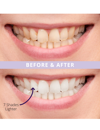 Magic Melt-Away Teeth Whitening by ELIMS. Clinically proven to lighten teeth upto 7 shades in 14 days. Totally enamel safe! Made for sensitive teeth. Before and after!